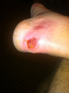 My Achilles Heel.  The blister was open, infected and my foot was swollen. 